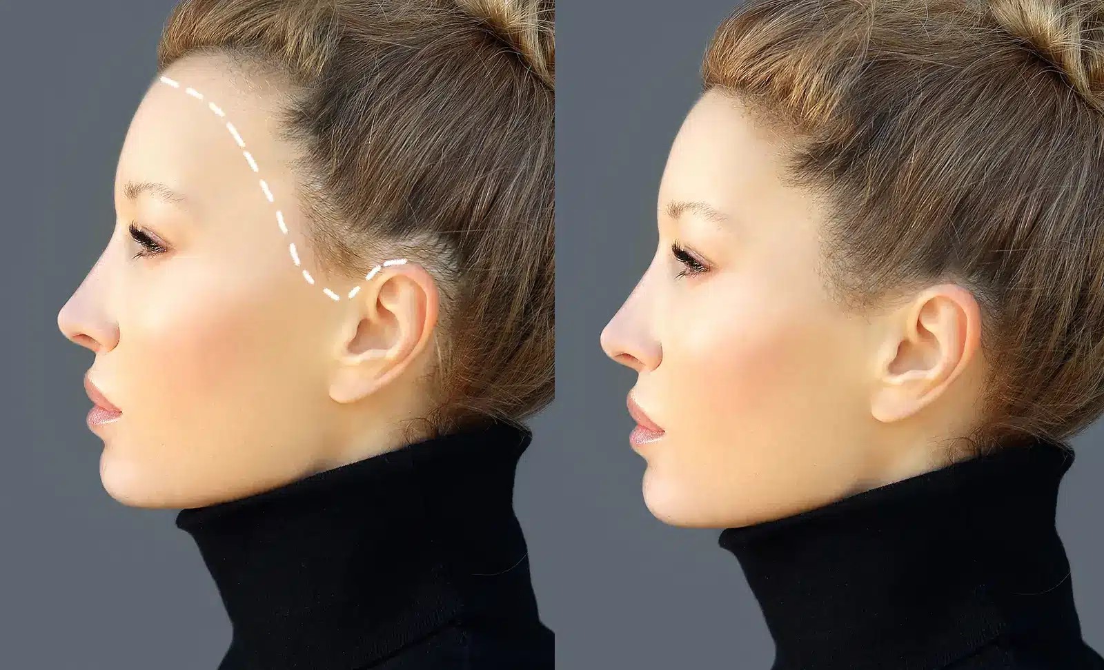 Roma, è boom di richieste di donne per trapianti di capelli